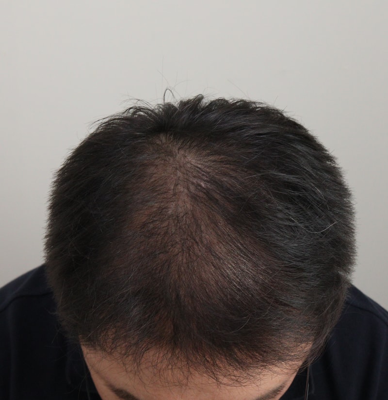 4. 수술후_6개월_2.JPG
