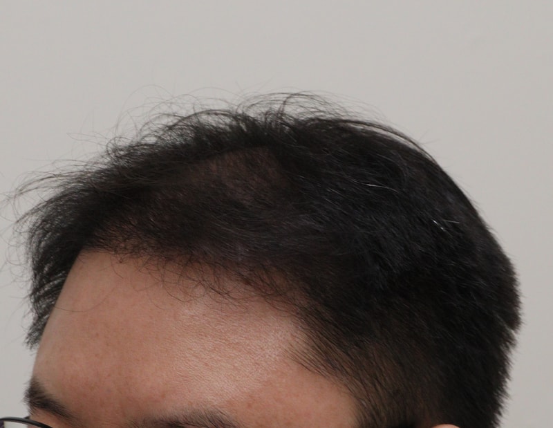 4. 수술후_6개월_3.JPG