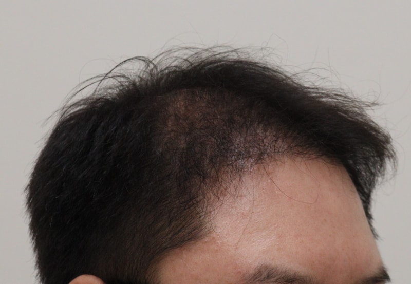 4. 수술후_6개월_4.JPG