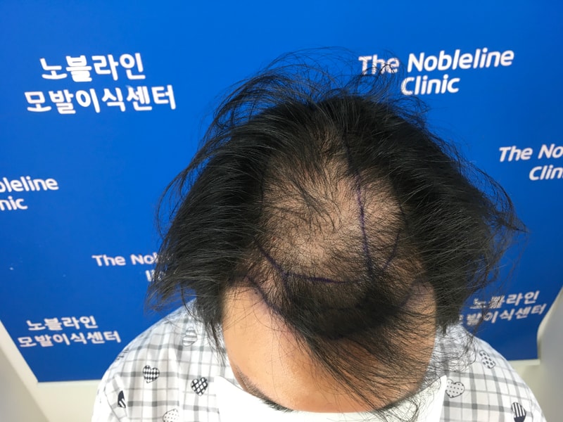 진짜 모발이식 너무나 강추 합니다 꼭 하세요