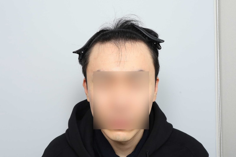 M-shaped forehead hairline 1200 follicle non-cut Hair Transplant + 1 year MO.1 plastic surgery for head tattoo