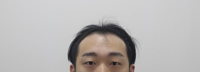 毛プロクリニック クリニック ヘアライン 植毛 非切開 4200本 1年1か月経過