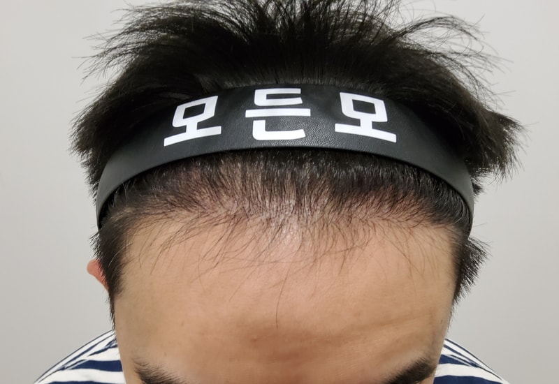 4. 수술후_6개월_1.jpg