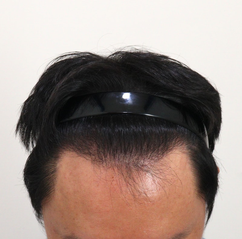 4. 수술후_8개월_2.JPG