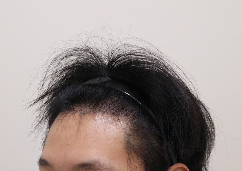 3. 수술후_6개월_2.JPG