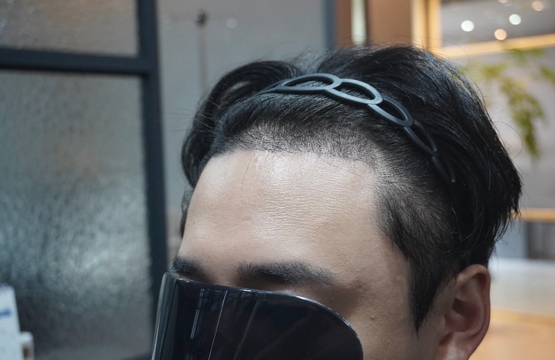 광주 압구정 모비앙 의원 모발이식 2주 경과 후기
