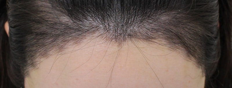 Shinsa Station Mopro Clinic / Family Introduction / Hairline Re-calibration Day 10