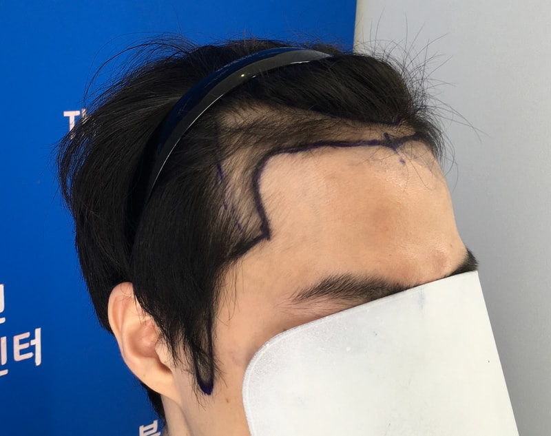 확실히 5개월이 되니 모발이식한 보람을 느낍니다