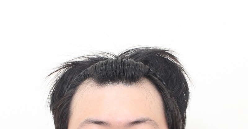 신사역,모프로의원,문건학원장님, 모발이식 비절개 3200모 + 측면, 1년 최종경과