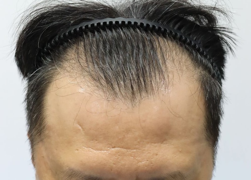 アプクジョン フォーヘア植毛クリニック深いM字薄毛の非切開スリット植毛、手術当日の体験談