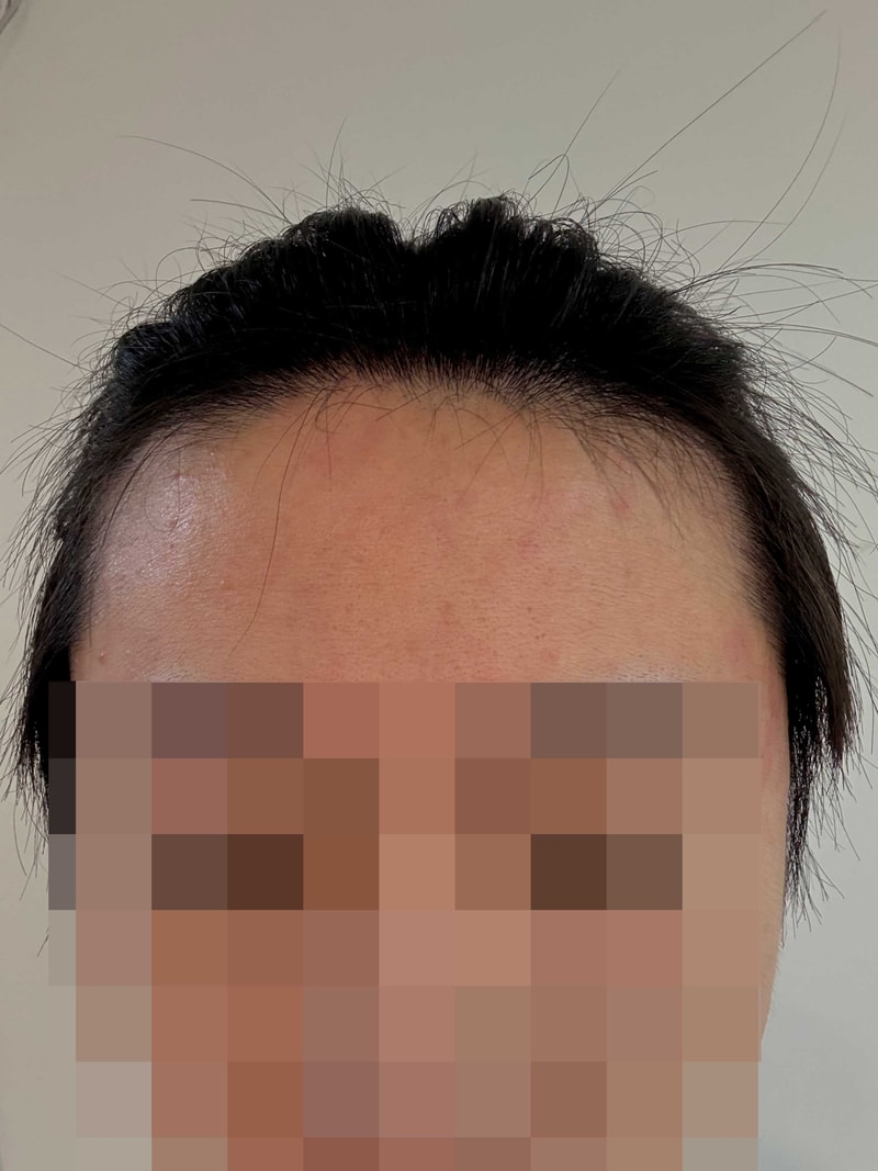 다나성형외과 무삭발 비절개 19개월 (수술 늦게하면 손해인 이유ㅠ)