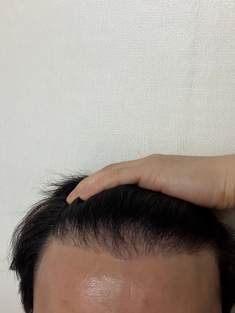 모발이식 10개월차 후기
