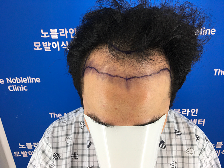 <모발이식수술 1년차 후기> 묻지도 따지지도 않고 저는 노블라인 확신합니다!