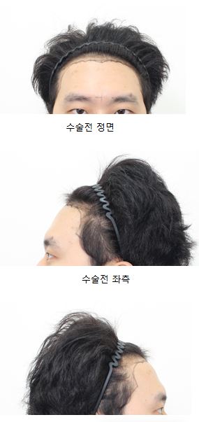 수술전.JPG