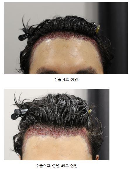 수술당일.JPG
