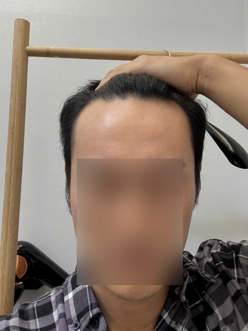 깊은 M자이마 무삭발 비절개 헤어라인 모발이식 1600모낭 모원성형외과 4개월차