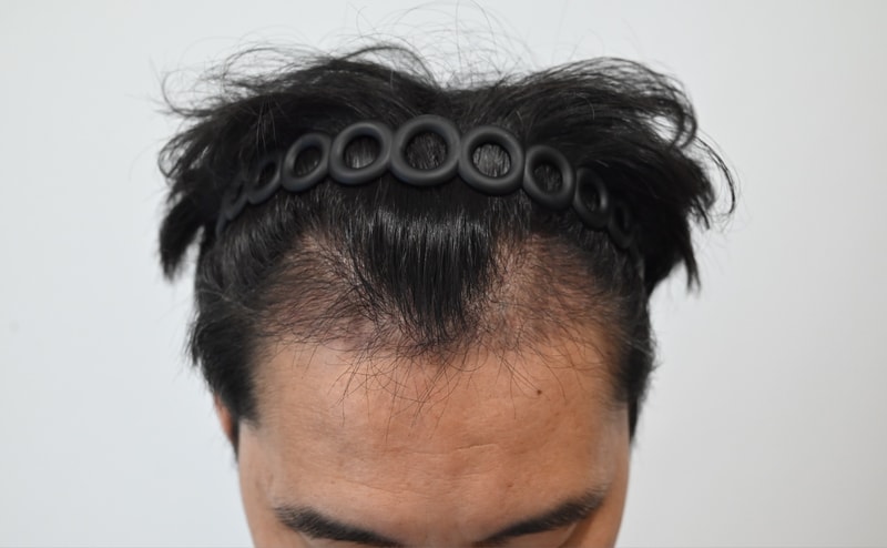 Hair Transplant 10th Month Review (Hidden Cut)
