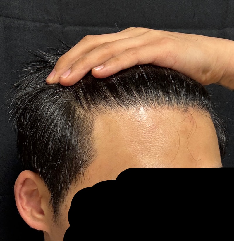 1400 hair follicles are less pacing in front of the mirror in the 10th month