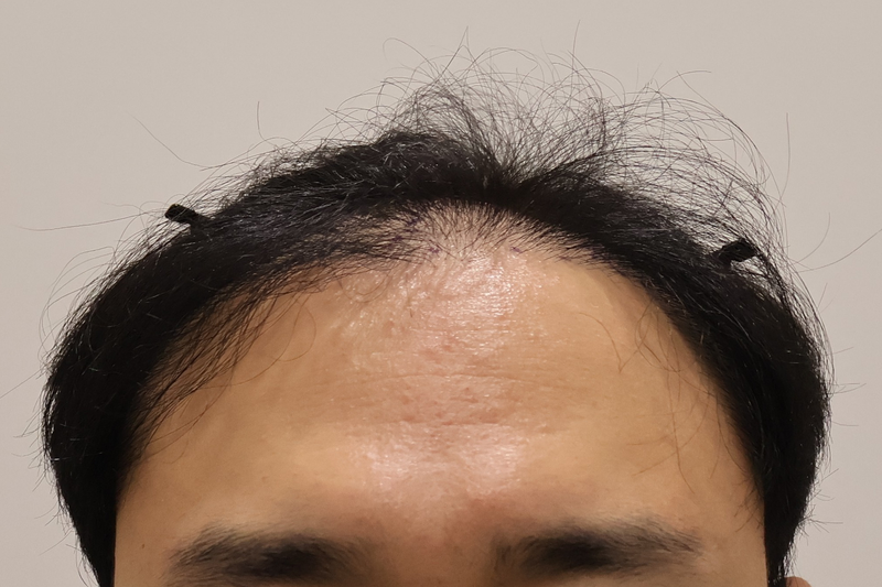 인천 마이모의원 비절개 모발이식 600모낭 2주 후기입니다