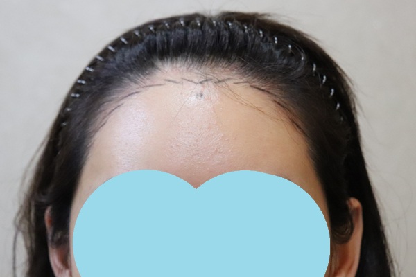 JP에서 헤어라인이식했는데 어때요?