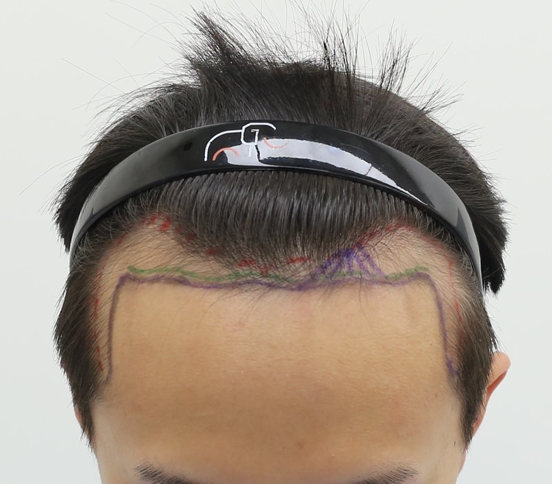 Apgujeong Mammoth Hair Restoration Center's wide forehead 4 months after the incision Hair Transplant