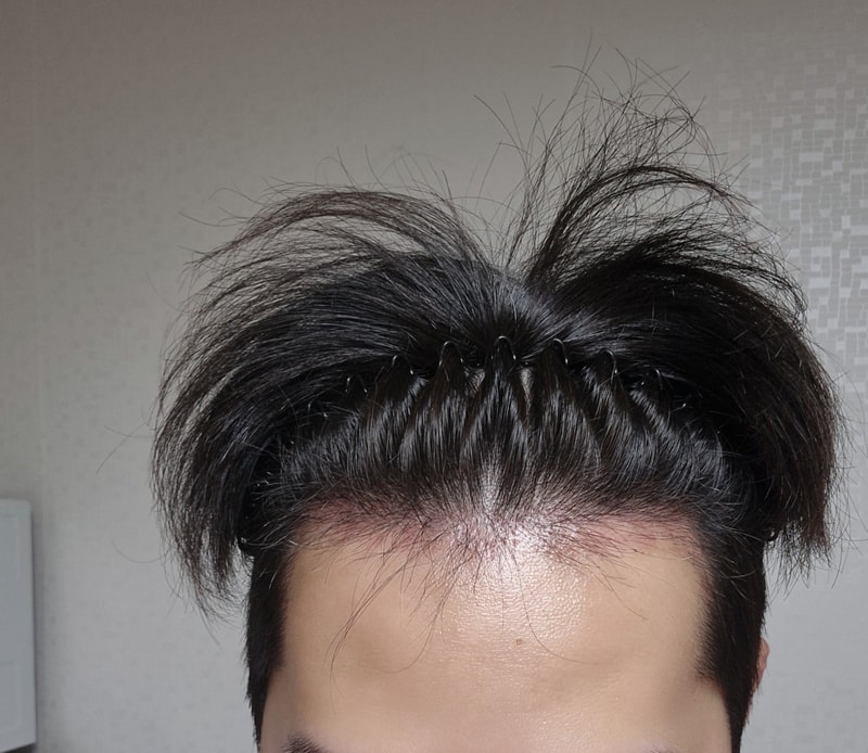 다나 무삭발 60일 (첫 수술 타협했다가 결국 재수술까지)