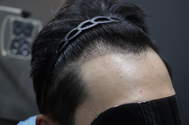 광주압구정모비앙의원 모발이식 2주 경과 후기