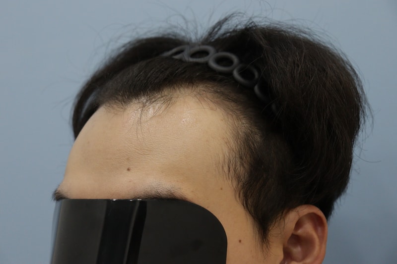 광주 압구정모비앙의원 모발이식 10개월 경과 후기
