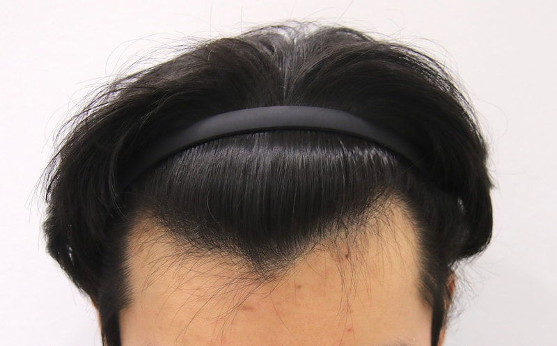 부산 맘모스 M자 모발이식 3년 이상 경과 후기