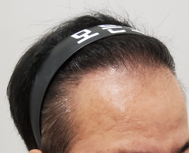 6. 수술후_1년_3.jpg
