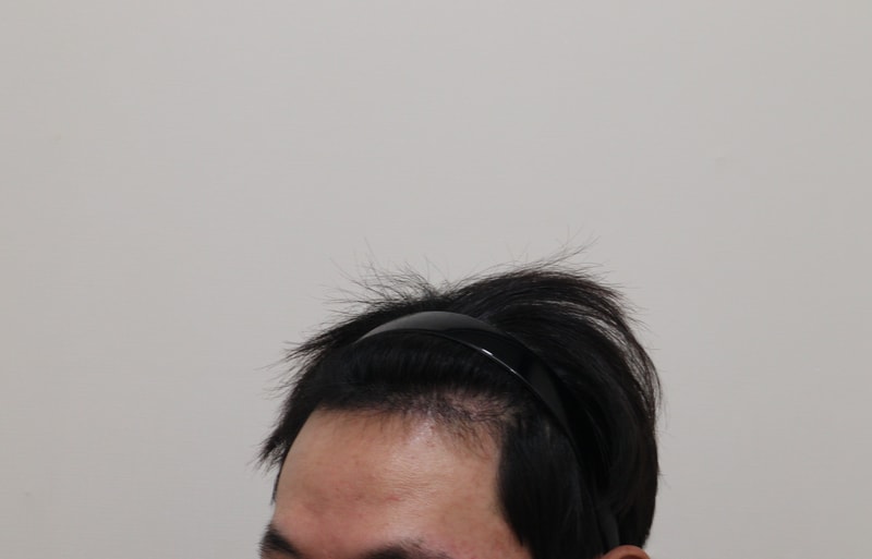 3. 수술후_6개월_2.JPG