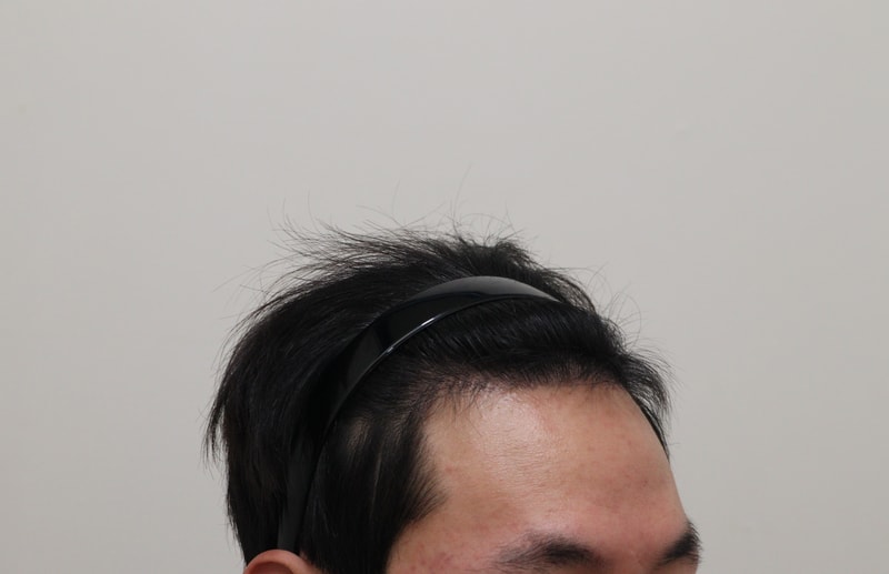 3. 수술후_6개월_3.JPG