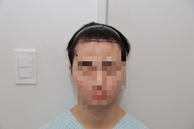 NEWHAiR Seoul Branch/ Non-Cutting/Review of the 1st Year of 3200 Mo Surgery