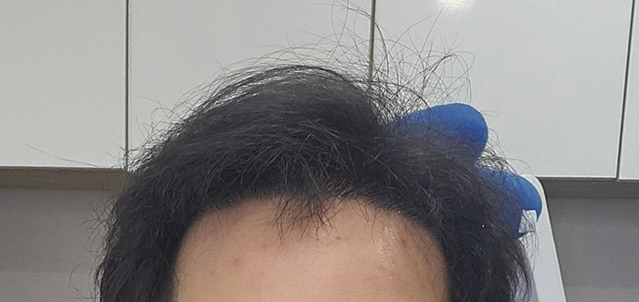 3. 지난번 후기에 남겼던 머리 올렸을 때 사진.jpg