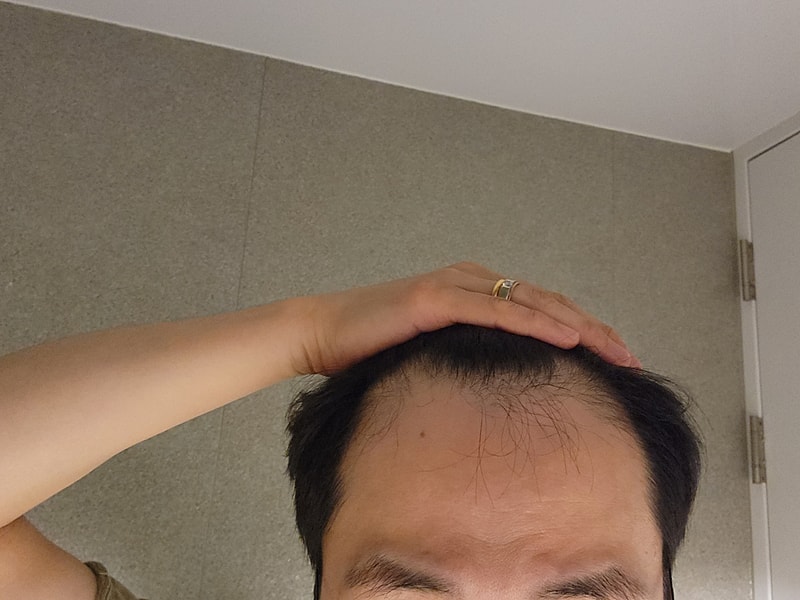 Late The Nobleline Center for Alopecia Care Hair Transplant (M-shaped men's hair loss 4000 fur)