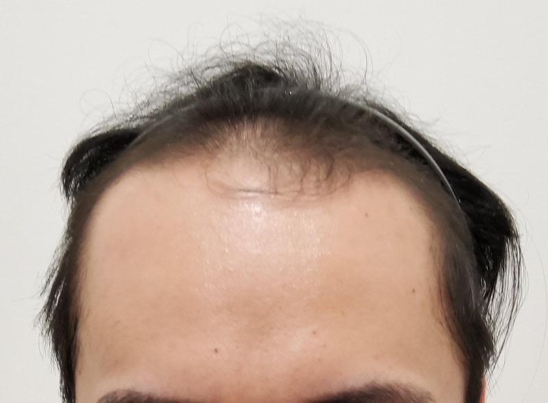 毛发移植3个月的时间...