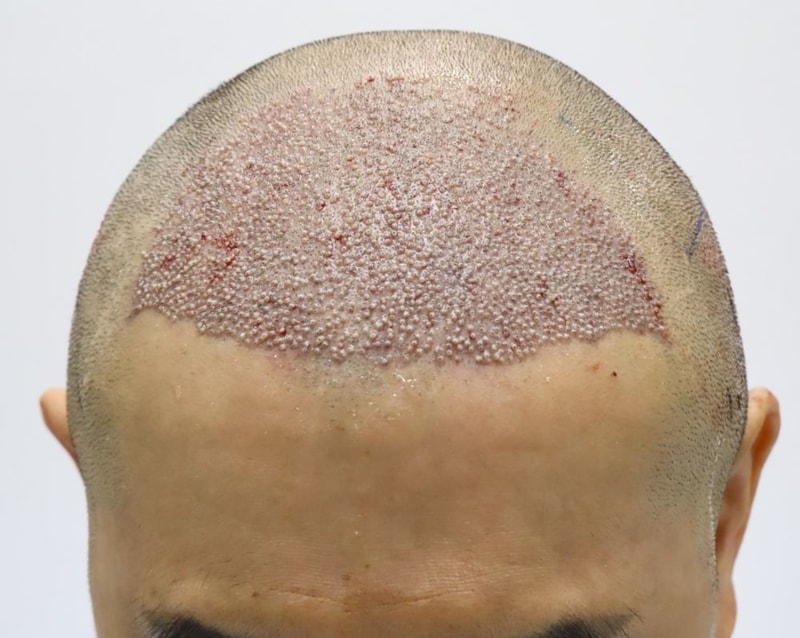 5.수술당일.JPG