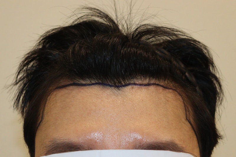 Raise the HAIRO HAIR TRANSPLANT CENTER Daegu 1400m no-cut non-cut after 9 months.
