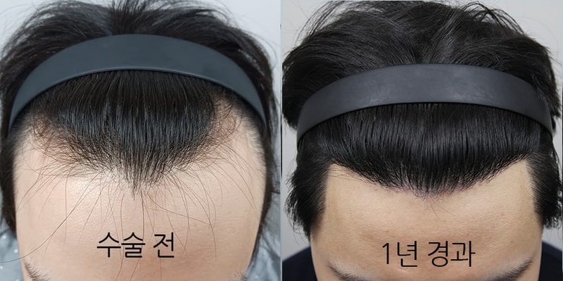  모나라 모발이식 12개월차 후기! 드디어 1년 꽉 채웠습니다!!