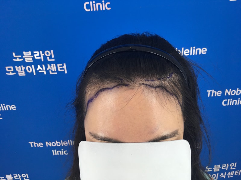 It's been 8 months since I transplanted my hairline!