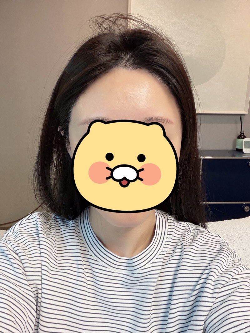 신사역,모프로의원,문건학원장님,헤어라인+구레나룻(재수술),모발이식1900모,6개월 중간경과