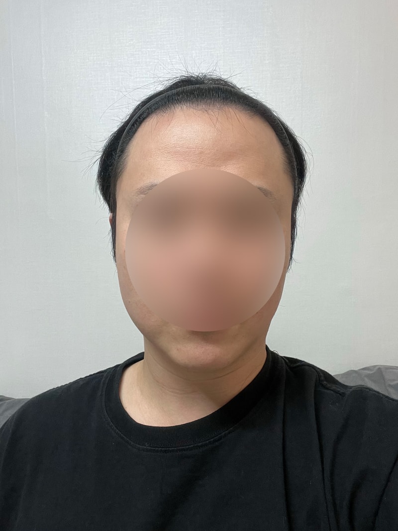 M자 이마 부분삭발 비절개모발이식 1년 모원성형외과 정재홍원장님