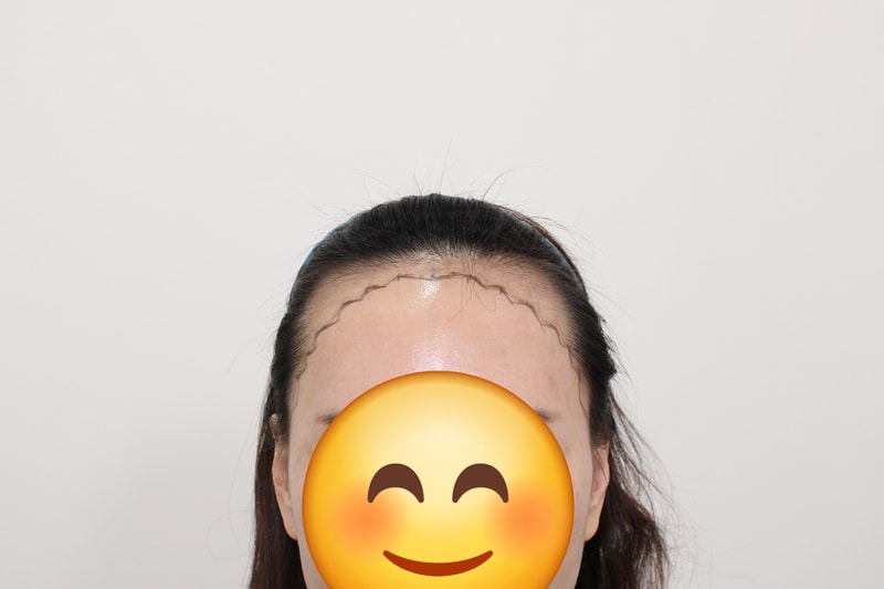 신사동 모프로 의원 문건학 원장님 4400모 헤어라인 이식 9일후기