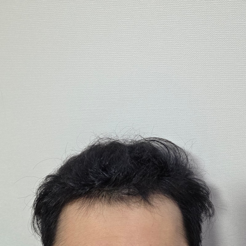 植毛から4か月経過した体験談