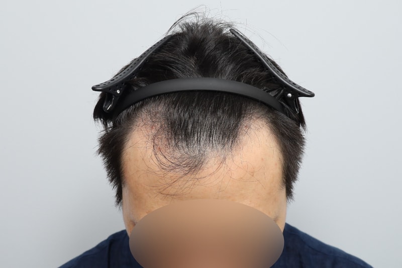 모원성형외과 무삭발비절개 모발이식 1850모낭 5개월차 정재홍원장님