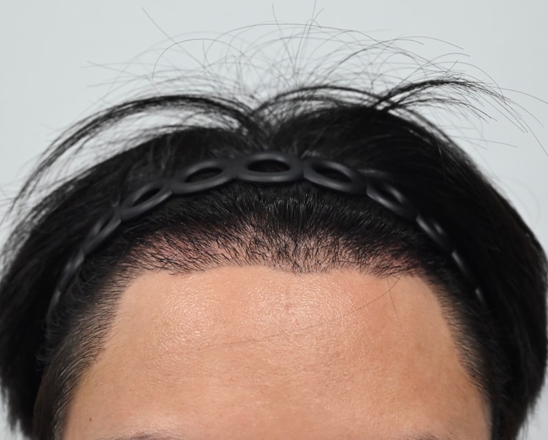 The 2nd week review of the non-cut hidden cut