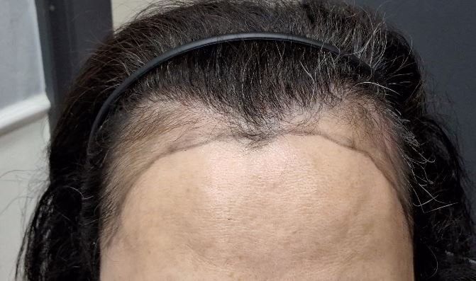 非切開毛髪移植 1週間体験談