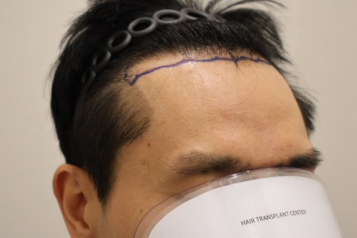9 months after non-cutaneous Hair Transplant of HAIRO HAIR TRANSPLANT CENTER Dongtan