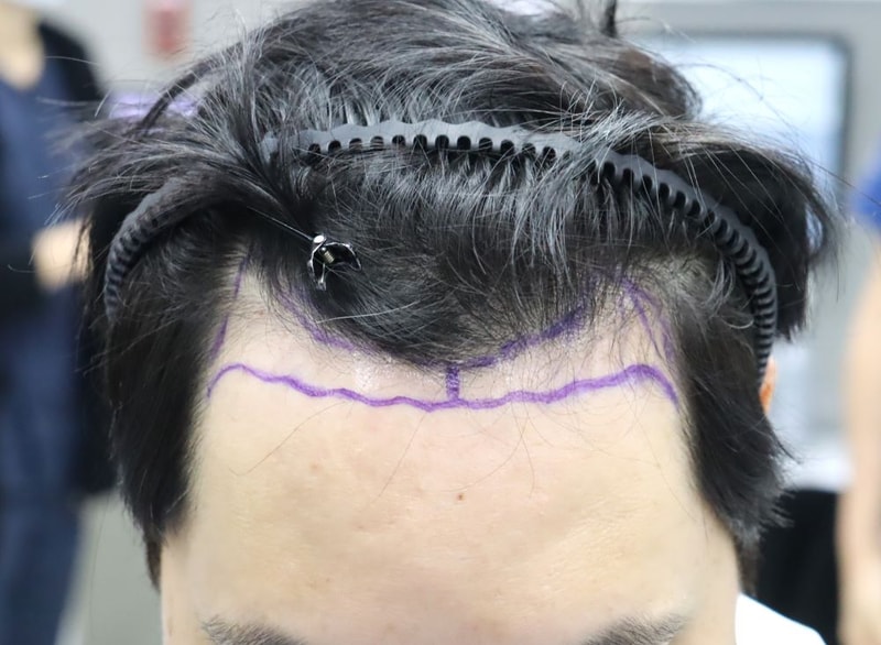 Apgujeong FORHAIR Hair Transplant Korea M-shaped hair loss + hairline down non-cut slit Hair Transplant surgery day review