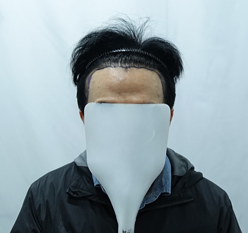 [자라다의원] 14일차 비절개 모발이식 후기